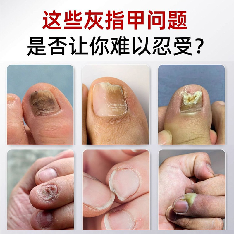 German Nail Fungus Pen, Nail Fungus Antibacterial Gel, Nail Protection and Maintenance All-In-One, No Need to Remove Nails, Nail Repair and Maintenance - Image 2